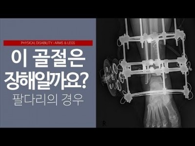 이 골절은 장해인가요? : 팔, 다리의 경우